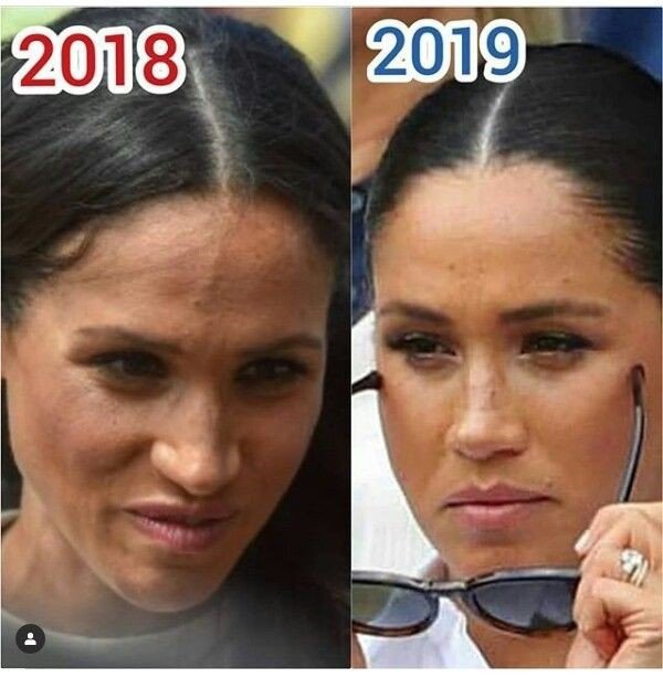 Meghan Markle Plastic Surgery – Nose Job, Teeth – before and after