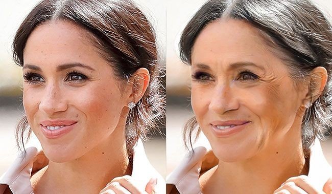 Meghan Markle Plastic Surgery – Nose Job, Teeth – before and after