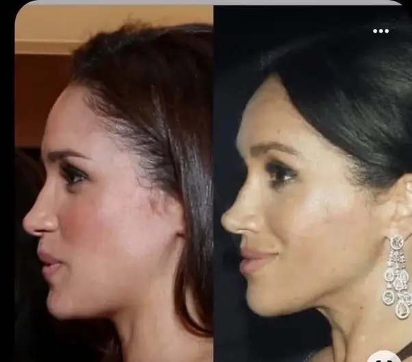 Meghan Markle Plastic Surgery and Trying to Look like Angelina Jolie’s perfect facial bone structure has Gone to Far.