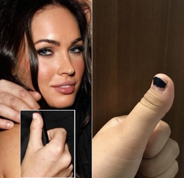 What Genetic Malformation Does Meghan Fox Have?