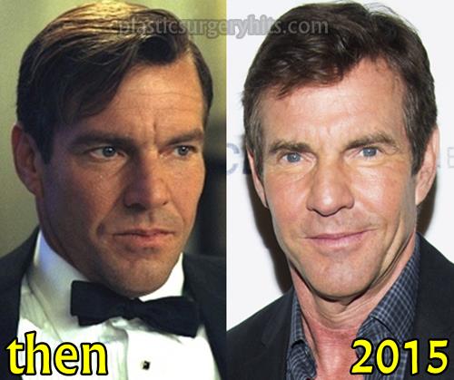 Dennis Quaid Debatable Plastic Surgery