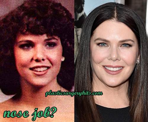 Lauren Graham Plastic Surgery Fact or Rumor