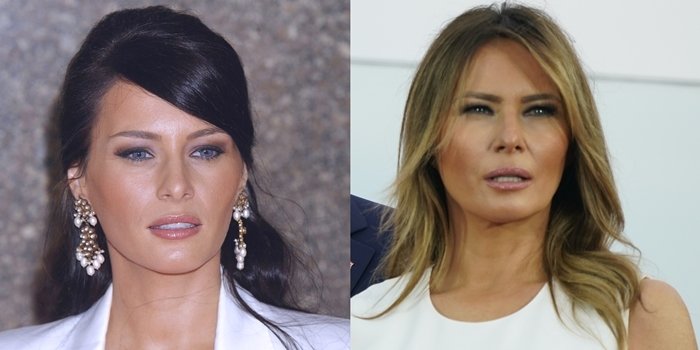 Melania Trump Plastic Surgery Before and After