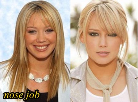 Hilary Duff Plastic Surgery Before and After
