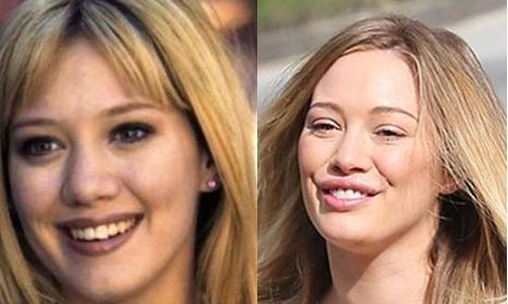 Hilary Duff Plastic Surgery Before and After
