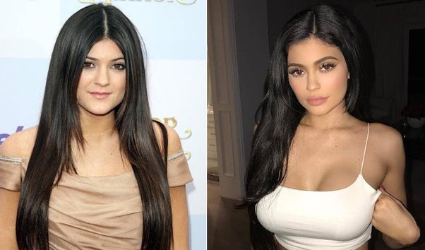 Has Kylie Jenner Had Plastic Surgery?