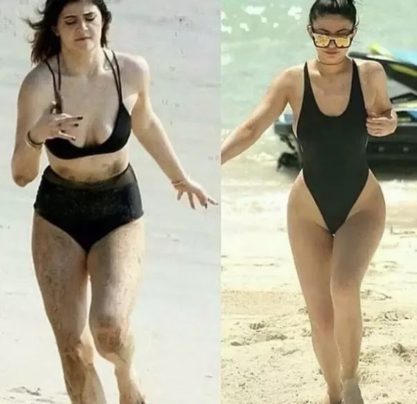 Has Kylie Jenner Had Plastic Surgery?