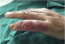 Flesh-eating bacteria: Scientists sound alarm over another climate change concern