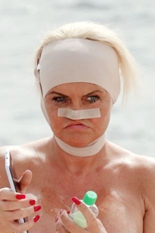 Danniella Westbrook enjoys TOPLESS __tanning session with bandaged head after hospital dash__