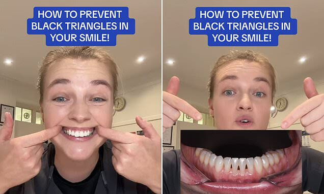 _What it means IF you have 'black triangles' between your teeth - and what to do if you spot them