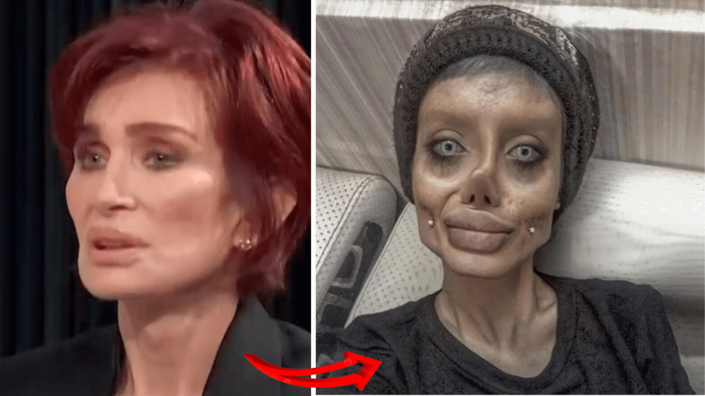 Sharon Osbourne Undergoes Plastic Surgery After Facelift Gone Wrong