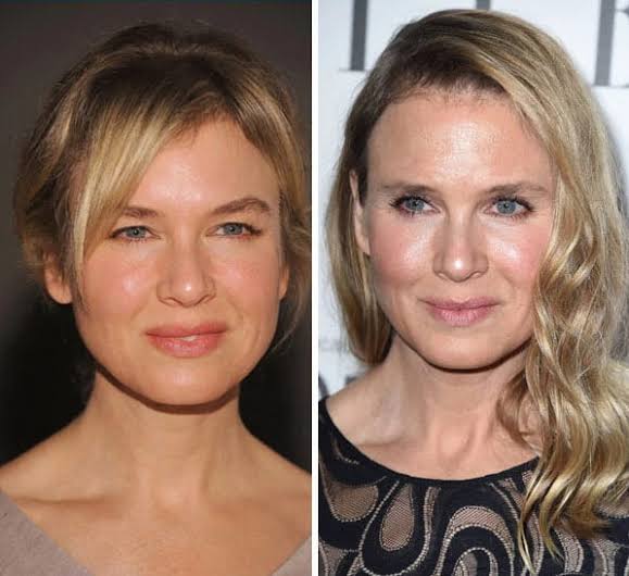 From Nightmare to Filler: Top 15 Celebrity Plastic Surgery That Made Us Wince