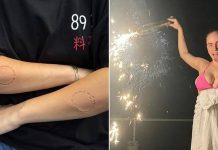 Billie Eilish sparks FEAR as she shares photos of her arms with bite marks and bruises: ‘Is she okay?’