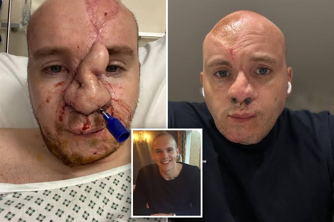 Man used his RIBS to rebuild his nose after it was ripped off by his dog