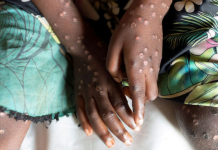 ‘MonkeyPox A Global Health Emergency’ – WHO