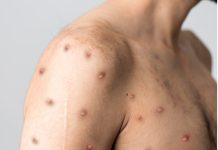 Sweden Reported Its First Case Of Dangerous Mpox Variant