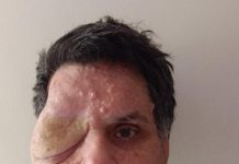 Man Asked To Leave Restaurant Because His Face Frightened Customers