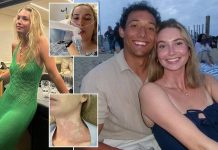 Woman, 25, suffers rare condition that means KISS!NG could be deadly for her